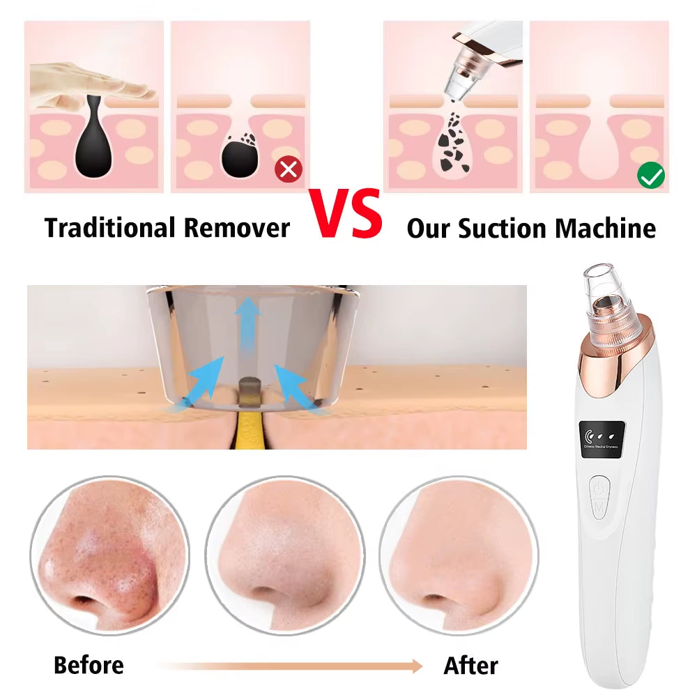 Facial Pore Cleaner, 5 Suction Power Blackhead Remover Pore Vacuum - USB Rechargeable Facial Pore Cleaner Kit